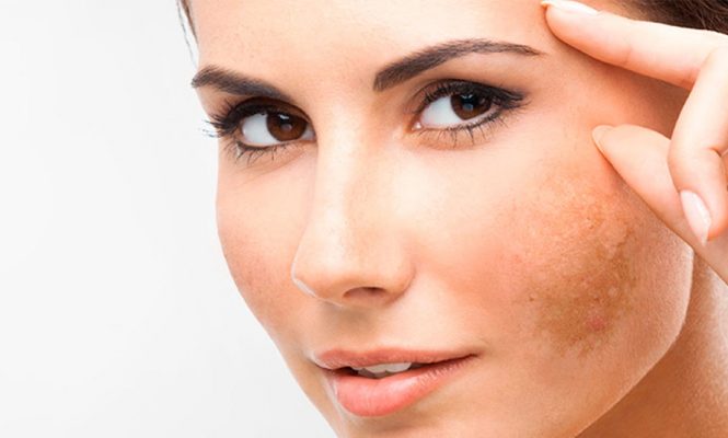 Melasma Cure