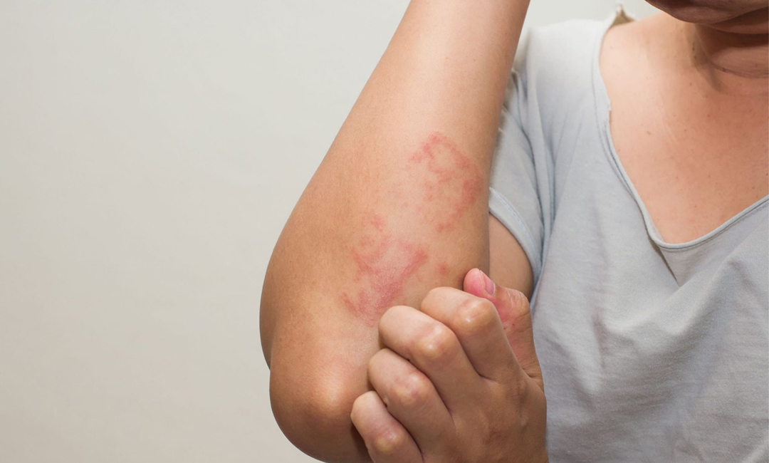 What is Eczema (Atopic Dermatitis) – Causes, Symptoms, Treatments
