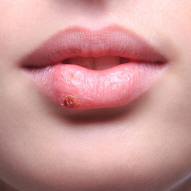 How Do You Get Rid Of Daunting Pimples On Lips?