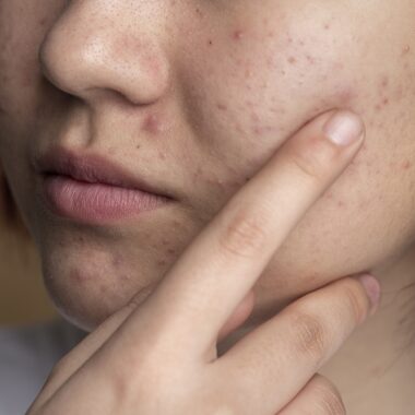 What Happens if You Stop Using Tretinoin?