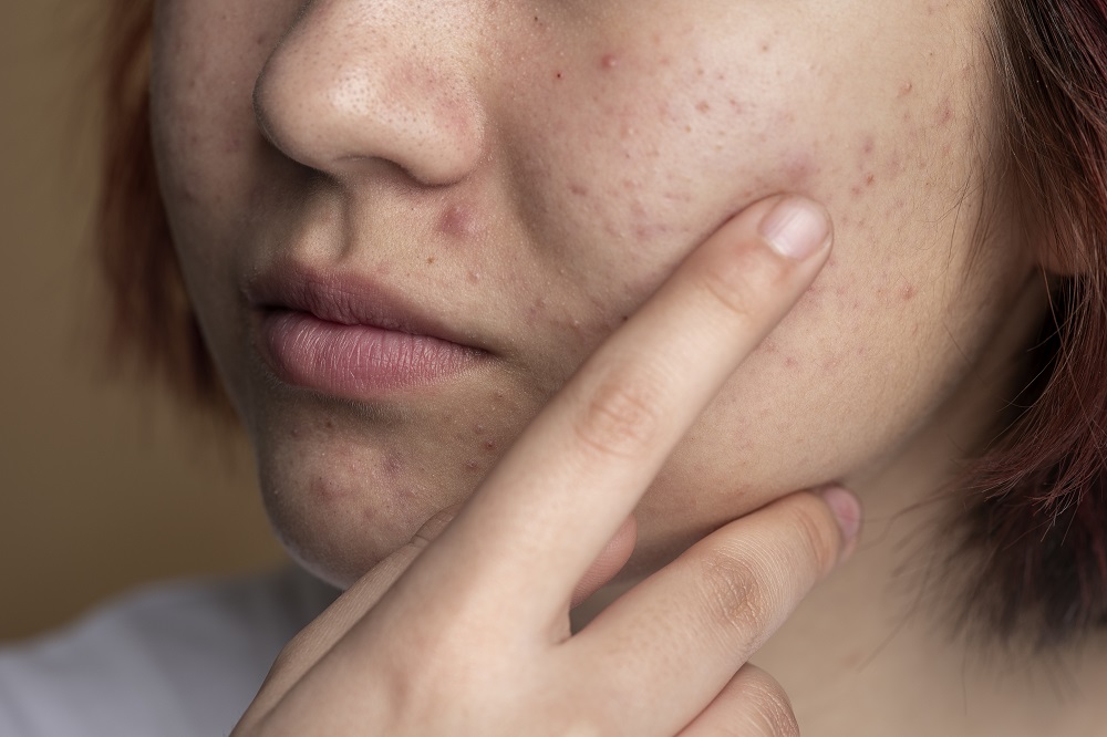What Happens if You Stop Using Tretinoin